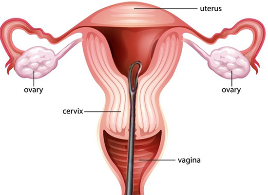 Dilation And Curettage