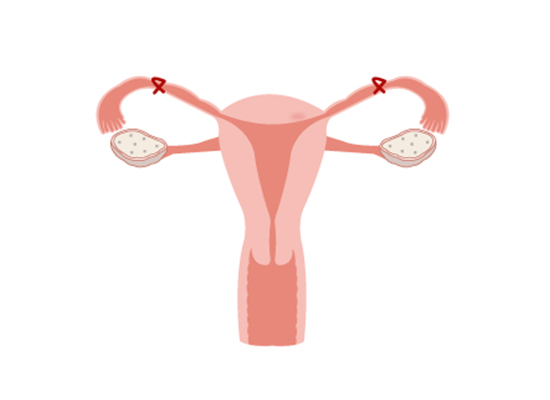 Female sterilization