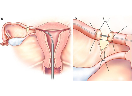 Hysteroscopic Tubal Cannulation