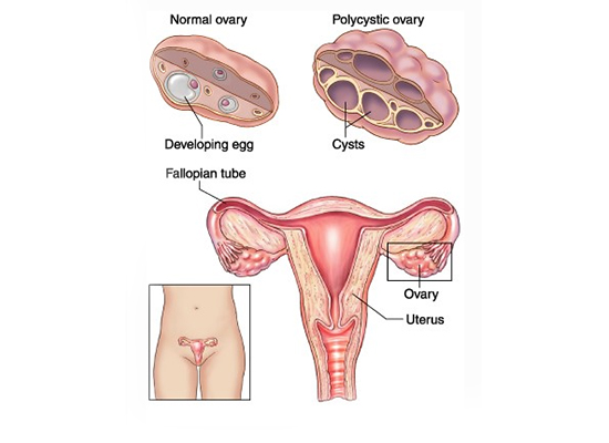 Ovarian Drilling for Poly Cystic Ovaries