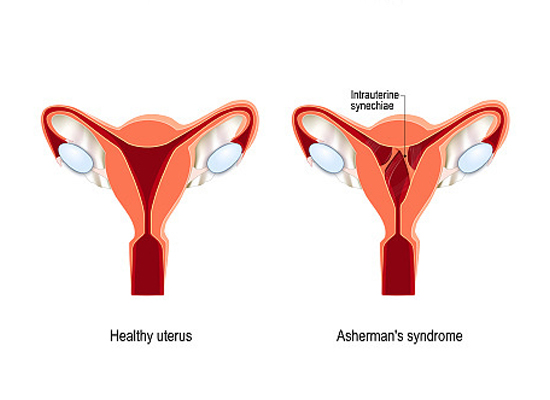 Release of Adhesions Adhesiolysis