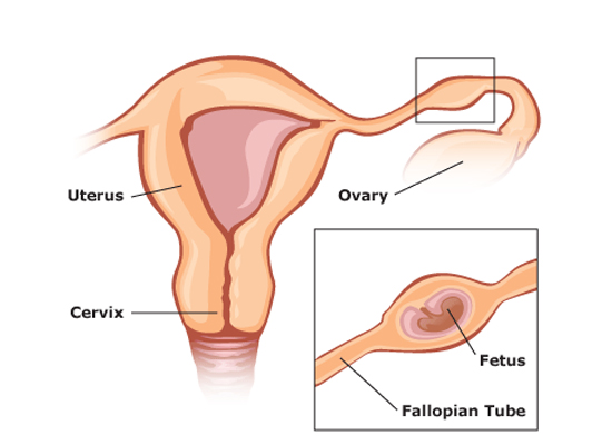Surgery for Ectopic Pregnancy